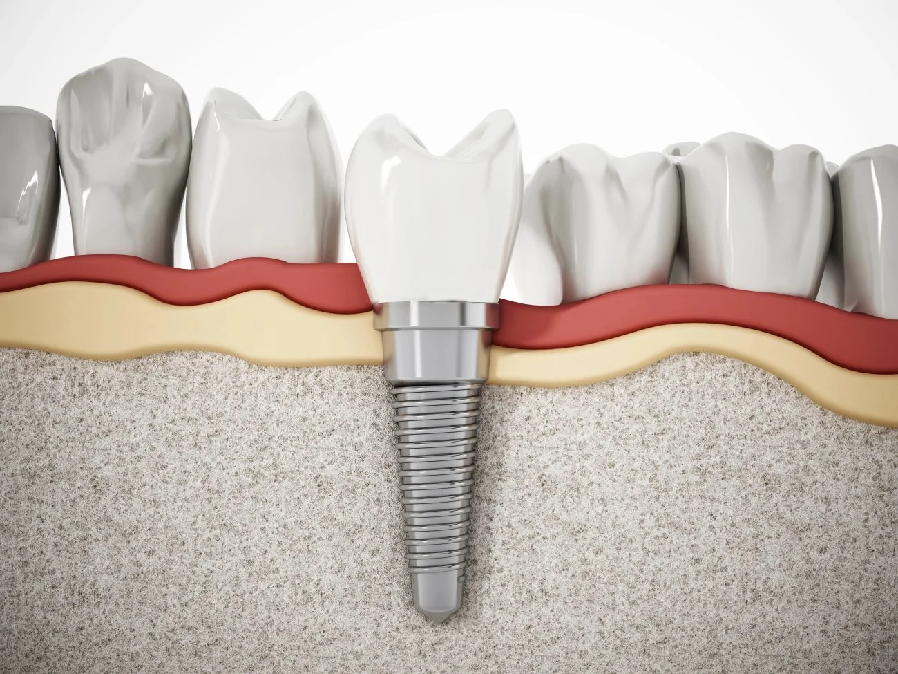 Korony na implantach – jak powstają i czym się różnią?