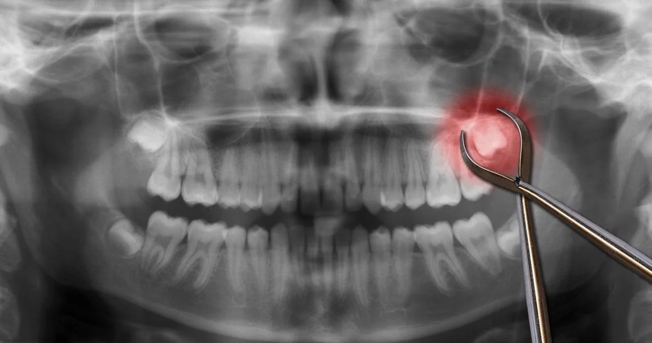 Kiedy usuwać ósemki i jak wygląda zabieg?